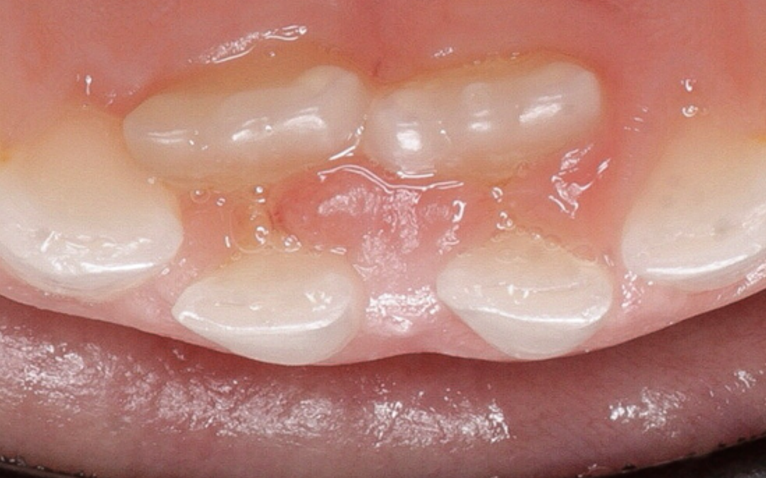 ¿Sabías qué… ? La erupción del primer diente