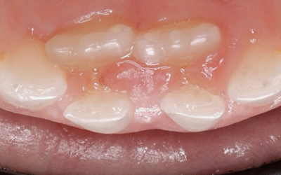 ¿Sabías qué… ? La erupción del primer diente